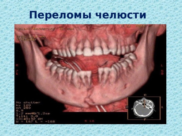 Переломы челюсти